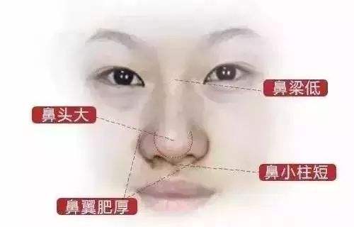 2025年成都鼻头整形效果解析