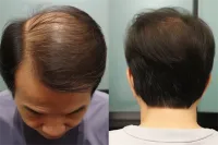 长沙植发专业医院排行及特色解析